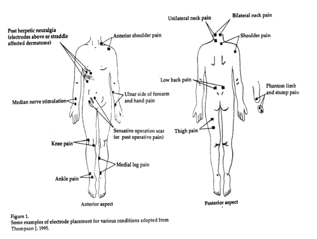 How to Use a TENS Unit: A Placement Guide